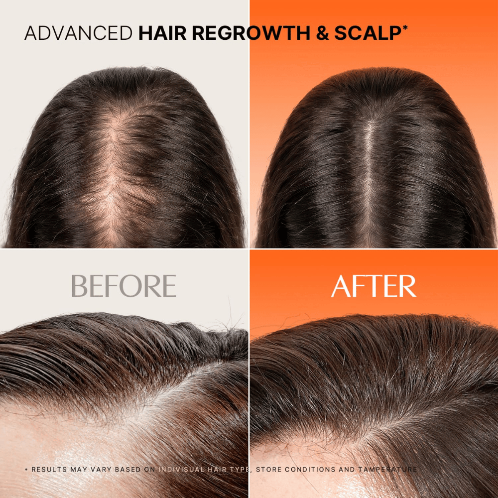 Imagen del antes y después del cabello y el cuero cabelludo al usar LILYEVE Grow Turn Exosome Spicule Ampoule 3000.