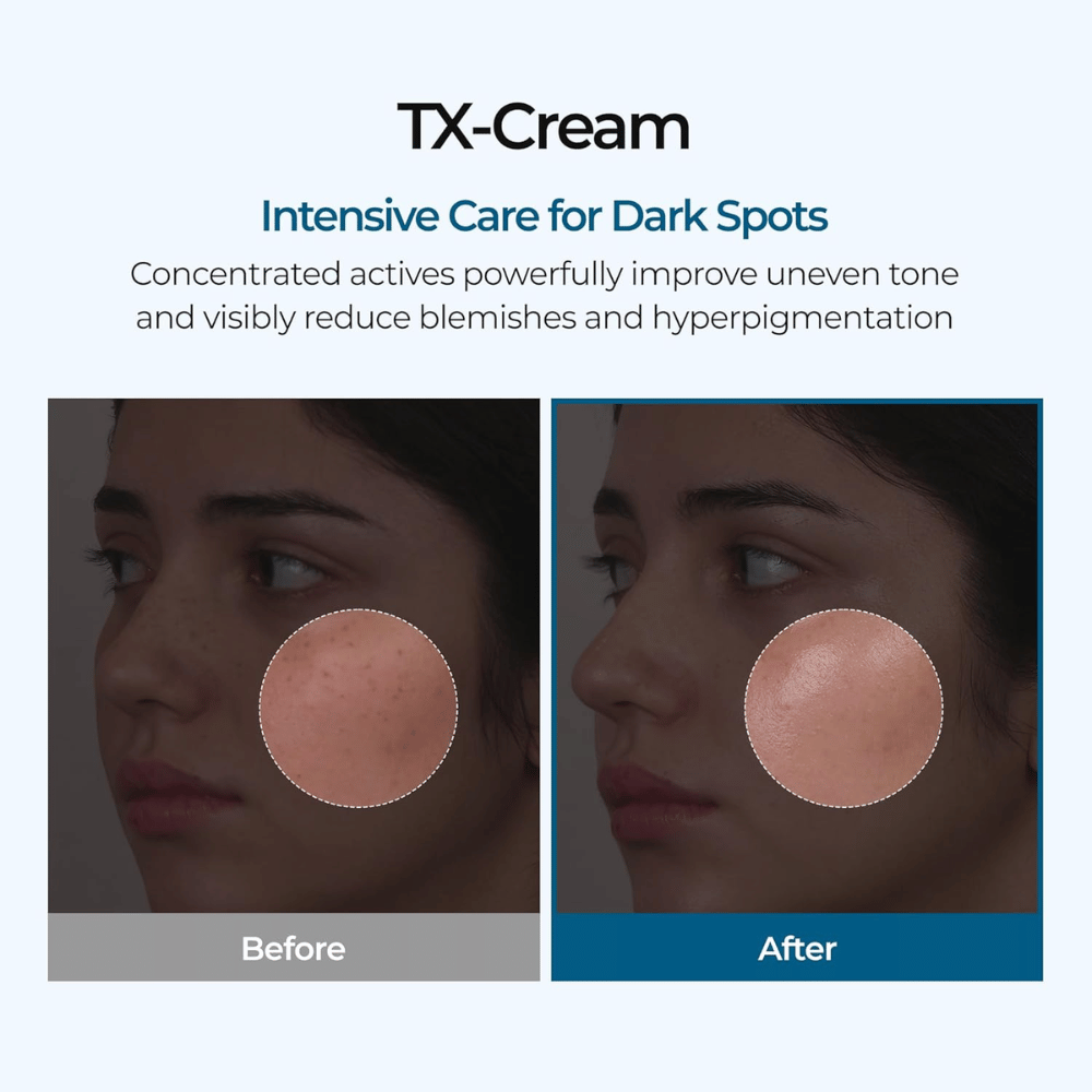 Resultados de antes y después con TX Cream que reduce las manchas oscuras y el tono desigual de la piel para una piel visiblemente más clara y uniforme