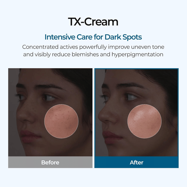 Resultados de antes y después con TX Cream que reduce las manchas oscuras y el tono desigual de la piel para una piel visiblemente más clara y uniforme
